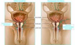 Robotic Prostate Surgery India